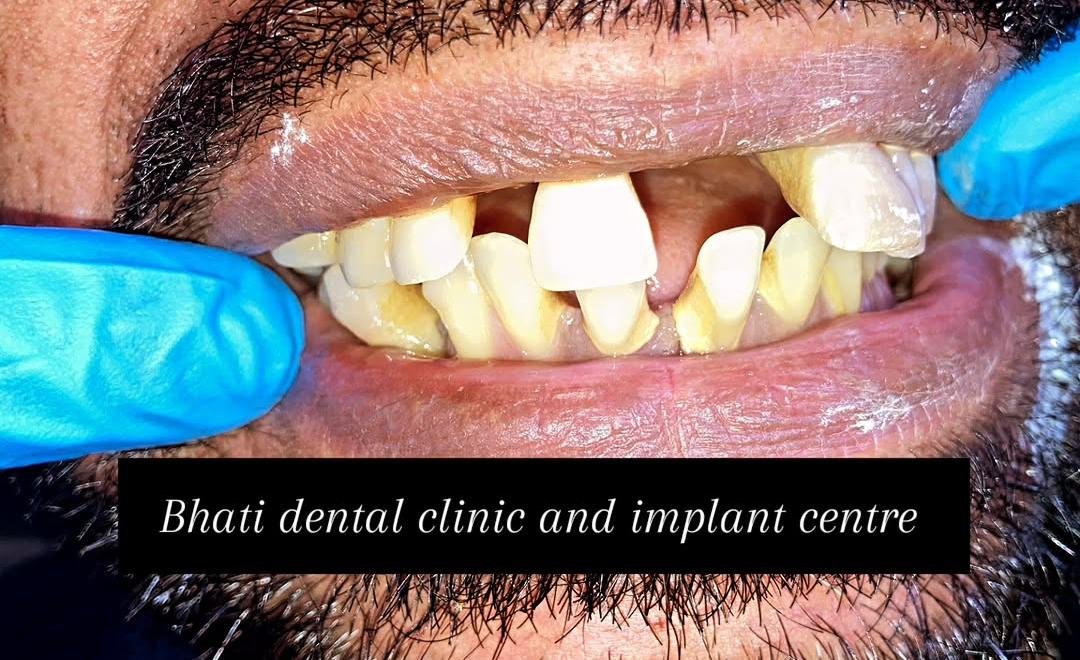 Before smile design treatment at Bhati Dental Clinic
